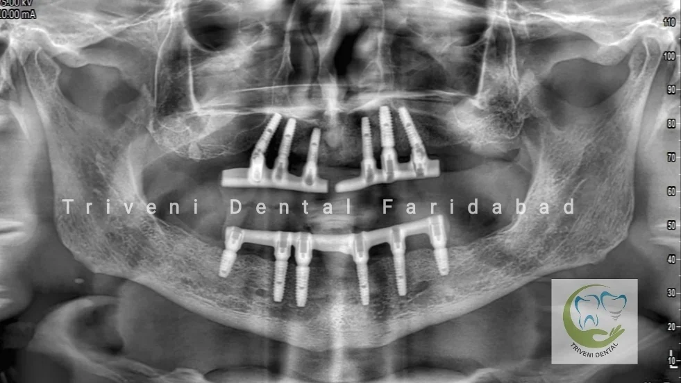 Full-mouth dental implant OPG X-ray